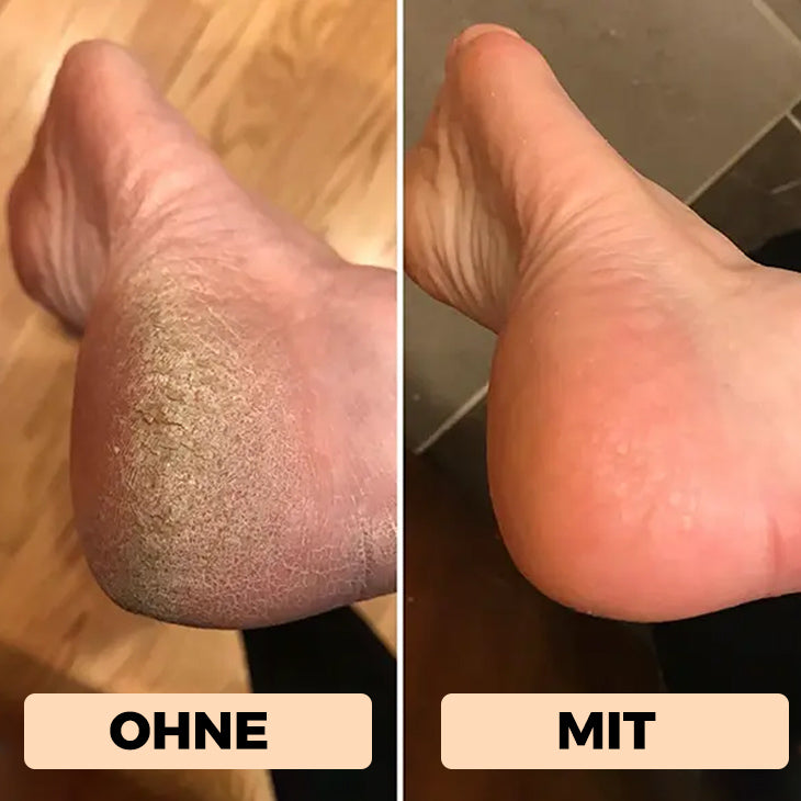 Hanna™ - Hornhautentferner Extra Walze