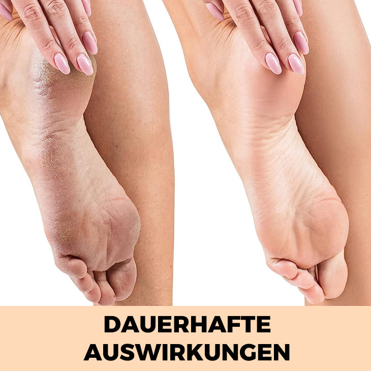 Hanna™ - Sagen Sie hallo zu glatten Füßen